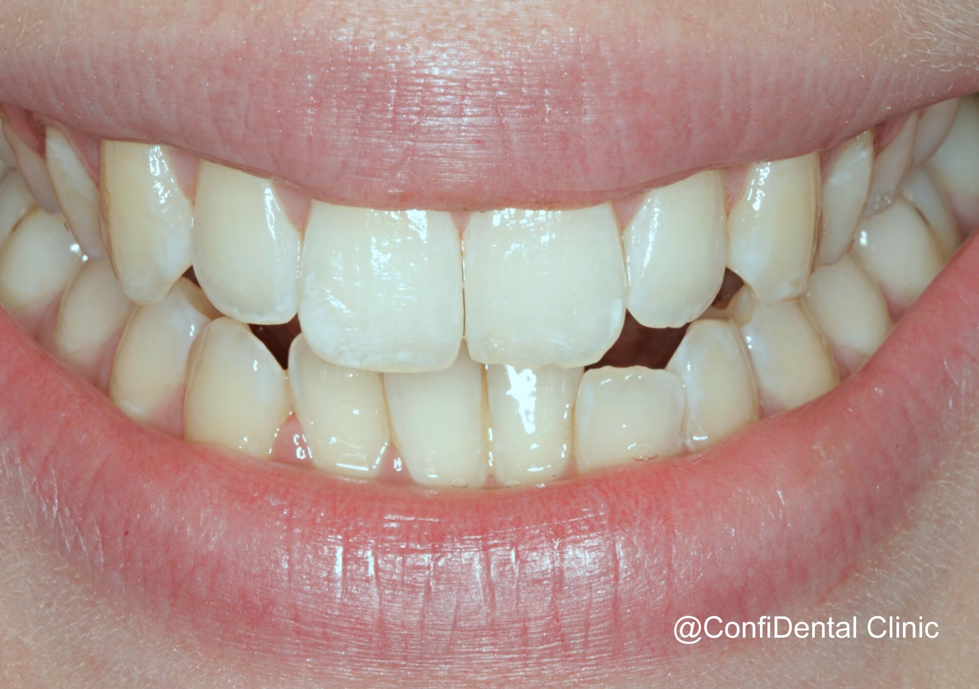Gallery Detail: Teeth Straightening In Worcesterpark